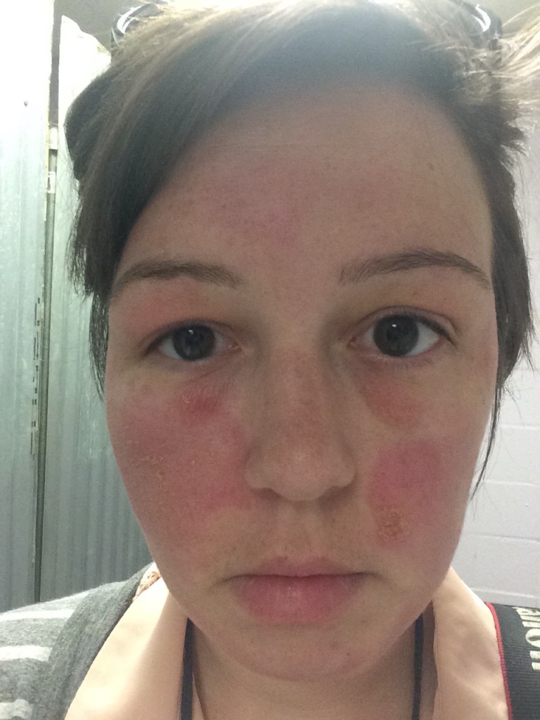 traveling with eczema